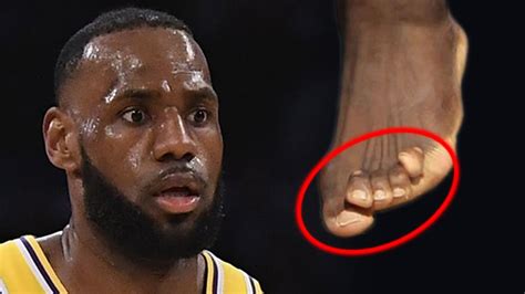 lebron james feet messed up